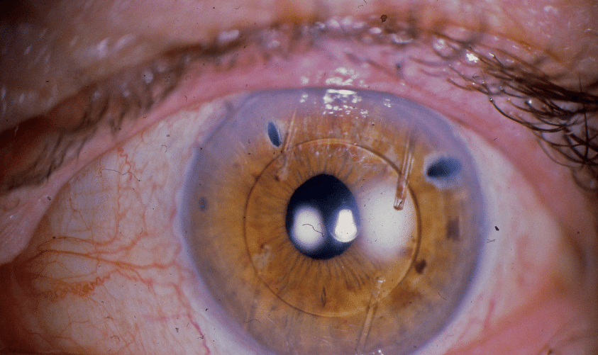 ¿El Lente Intraocular se utiliza toda la vida?