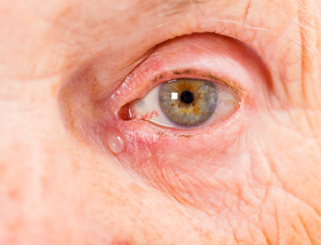 Lagrimal inflamado: Causas, síntomas y tratamiento