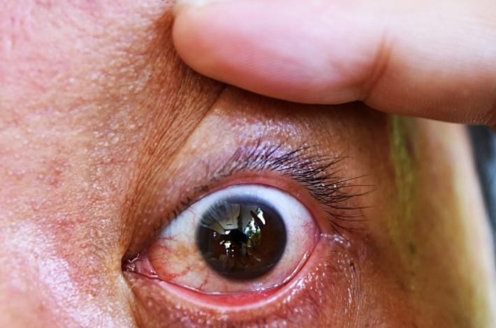 Ectropión: Qué es, causas, síntomas y tratamientos