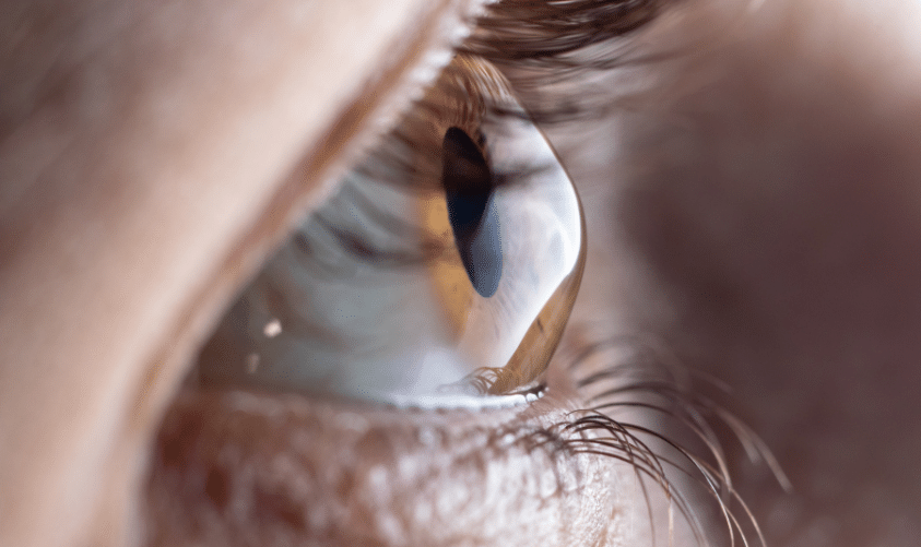 Lente confortable para Queratocono